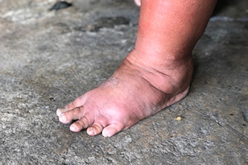 Swelling of the Feet