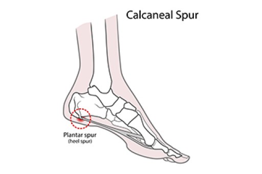 Reasons a Heel Spur Can Develop