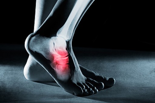 Dealing with Stress Fractures of the Foot and Ankle