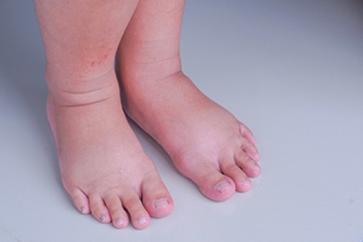 Exploring Causes of Swollen Feet