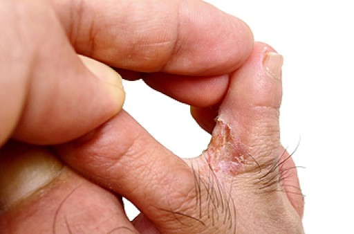 Symptoms and Treatment for Athlete's Foot