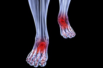 Arthritic foot care in the Ventura County, CA: Thousand Oaks (Simi Valley, Camarillo, Moorpark, Oak Park) and Los Angeles County, CA: Calabasas, Cornell, Agoura Hills areas