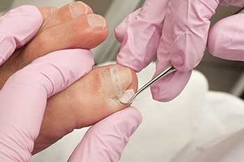 Ingrown toenail treatment in the Ventura County, CA: Thousand Oaks (Simi Valley, Camarillo, Moorpark, Oak Park) and Los Angeles County, CA: Calabasas, Cornell, Agoura Hills areas